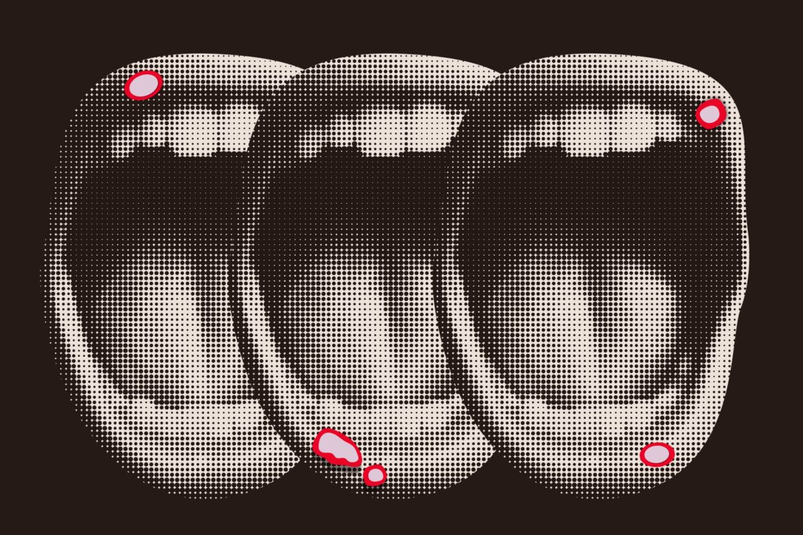 A Guide to Treating and Avoiding Canker Sores